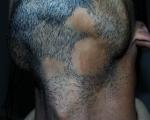 Alopecia Areata on the Beard